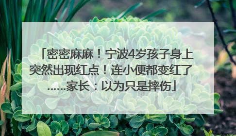 密密麻麻！宁波4岁孩子身上突然出现红点！连小便都变红了……家长：以为只是摔伤